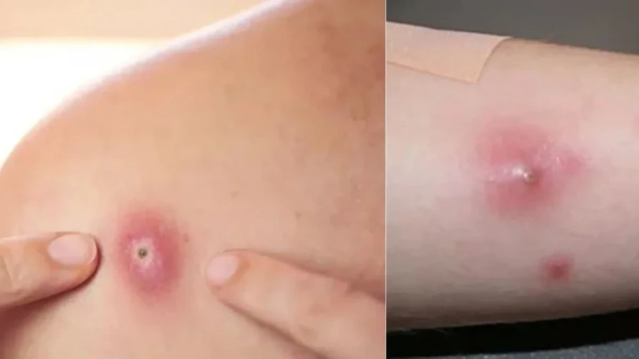 Relief From Boils: Effective Home Remedies To Treat Pain And Swelling Of Baaltod