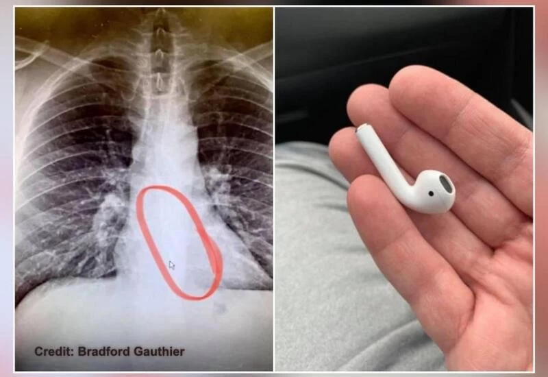 Man visits doctor with chest pain, X-ray reveals he swallowed AirPod while sleeping