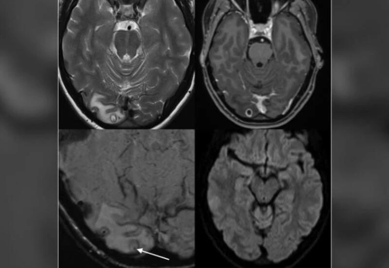 Aus woman finds she had tapeworm larvae in brain after week-long headache