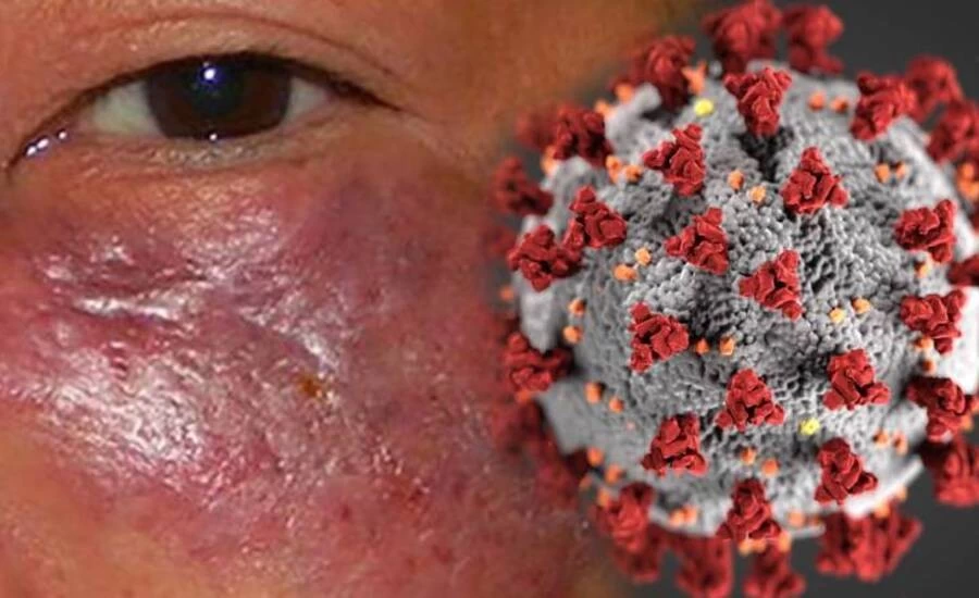 What is Mucormycosis or Black Fungus Symptoms and treatment