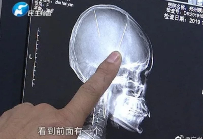 2 needles found in woman's brain who underwent CT scan after accident