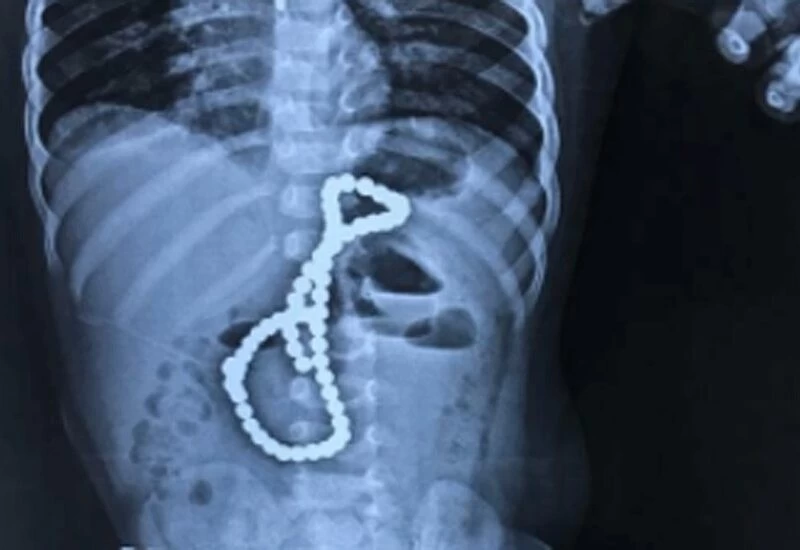 डेढ़ साल का बच्चा चुम्बक की 65 गोलियां निगल गया, 5 घंटे हुआ ऑपरेशन