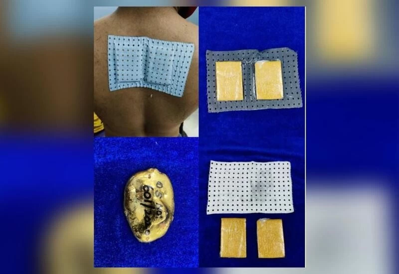 Gold worth ₹7.5L hidden under bandage on man's back seized at Chennai airport