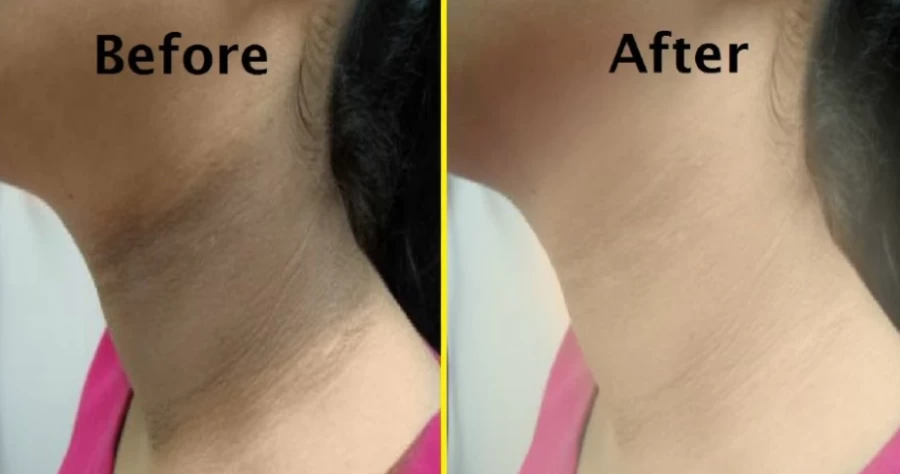 घर बैठे गर्दन के कालेपन को आसानी से हटा देंगे यह उपाय, साफ हो जाएगी स्किन