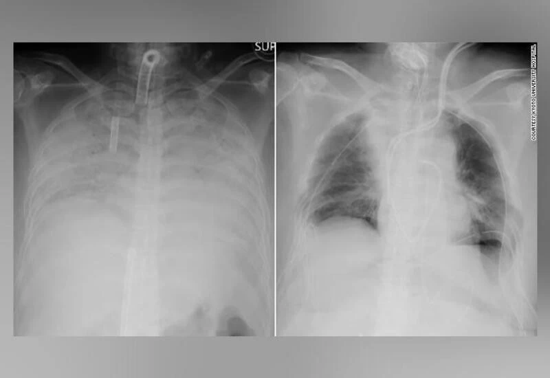 दुनिया में पहली बार जीवित डोनर का फेफड़ा कोविड-19 मरीज़ में हुआ प्रत्यारोपित