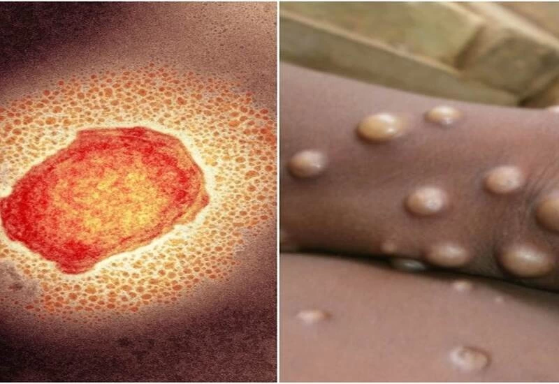 Monkeypox Outbreak: Super spreader became a festival of homosexuals in Belgium