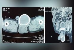 80-year-old man develops 'eggshell' of calcium around his swollen testicle