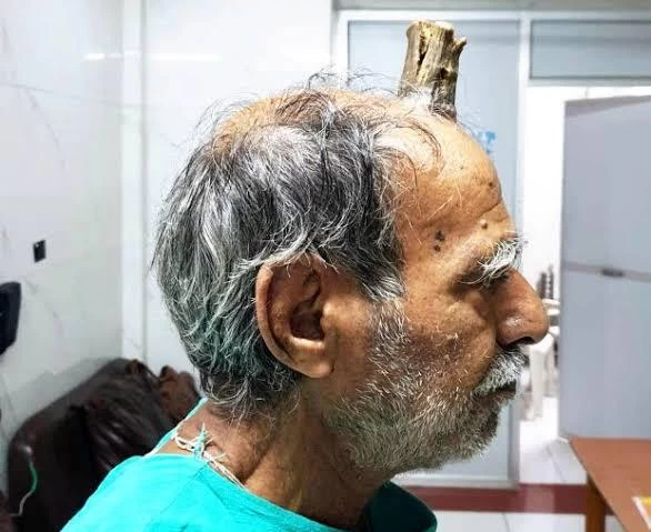 74 साल के किसान के सिर पर निकल आया सींग, डॉक्टर्स भी देखकर हैरान