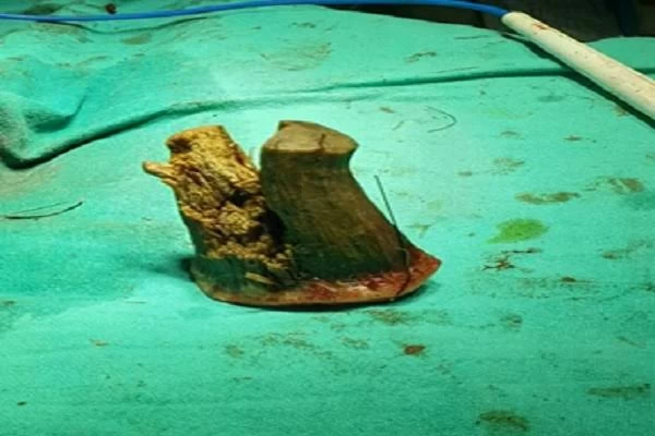 74 साल के किसान के सिर पर निकल आया सींग, डॉक्टर्स भी देखकर हैरान