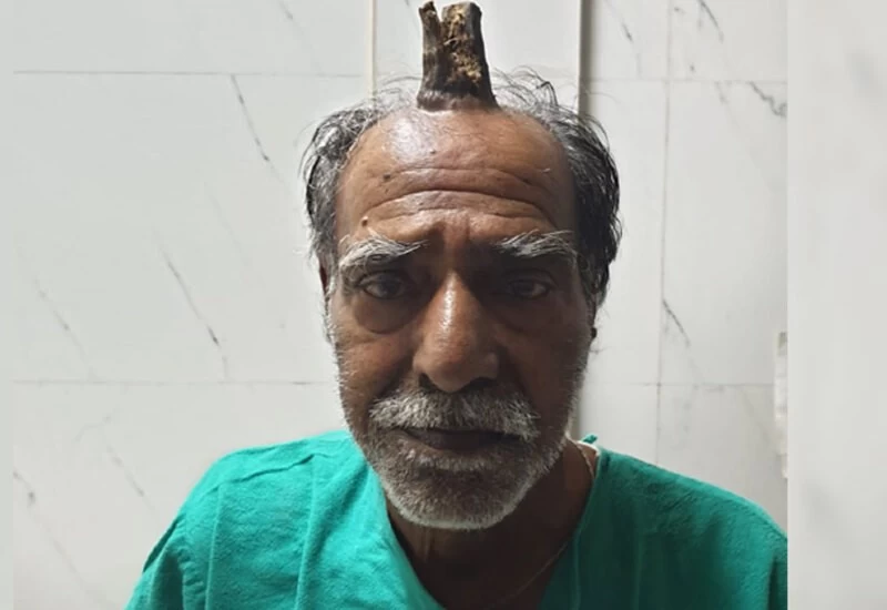 74 साल के किसान के सिर पर निकल आया सींग, डॉक्टर्स भी देखकर हैरान
