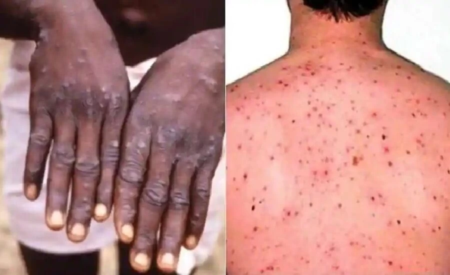 Monkeypox cases found in North Wales UK, public health agencies taking preventing infection