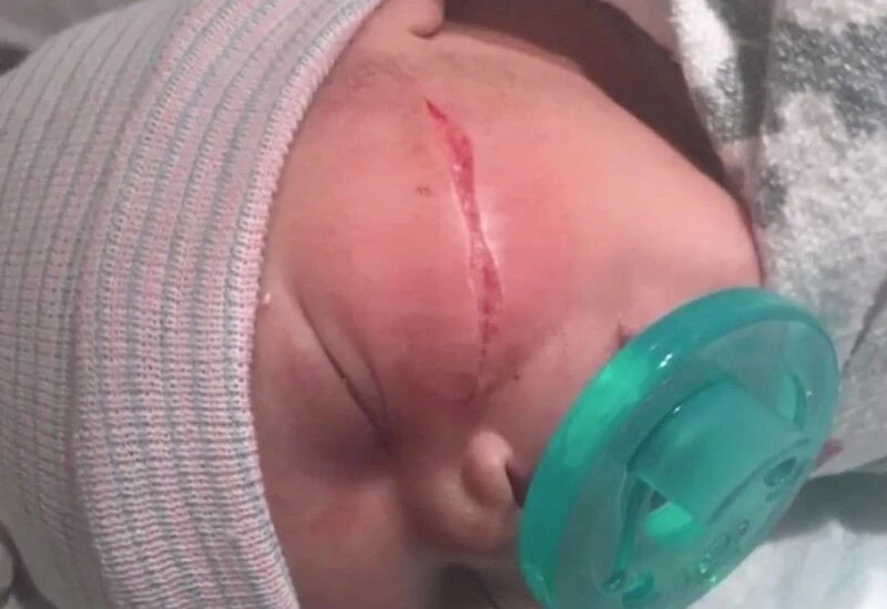 दर्दनाक.. डिलीवरी के दौरान बुरी तरह कटा बच्ची का चेहरा, लगे 13 टांके